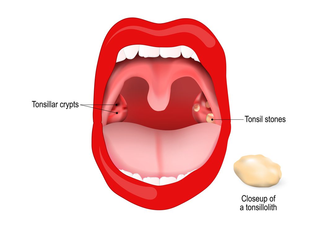 Remove tonsil stones